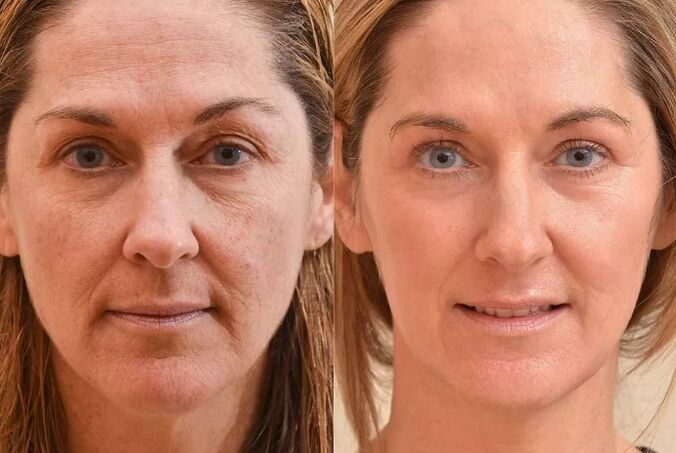 Verjüngung des Gesichts vor und nach