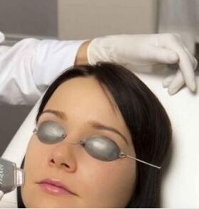 Feldlaserverjüngung