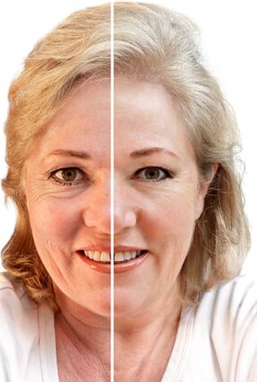 Verjüngung des Gesichts