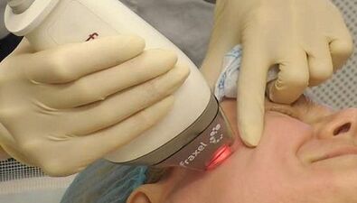 Wie wird eine fraktionierte Hautverjüngung durchgeführt