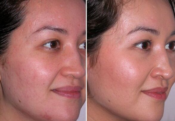 Mikrodermabrasion-Kurs