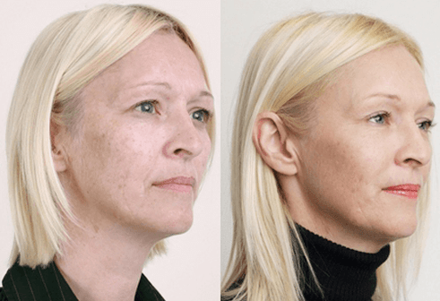 Mittleres Peeling mit Fruchtsäuren