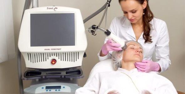 Fraktionierte Laser-Hautverjüngung