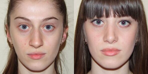 Mädchen vor und nach der Plasma-Gesichtshautverjüngung