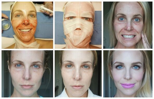 Stadien der Heilung der Gesichtshaut nach erfolgreichem Plasma-Lifting